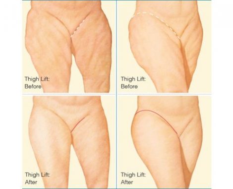 7 Aftercare Tips for Thigh Lift Surgery - Harley Clinic