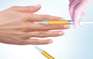 Filler treatments Before and after images showing hand rejuvenation using dermal filler and PRP