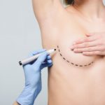 Breast lift surgery london finchely