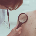Skin cancer mole check north london