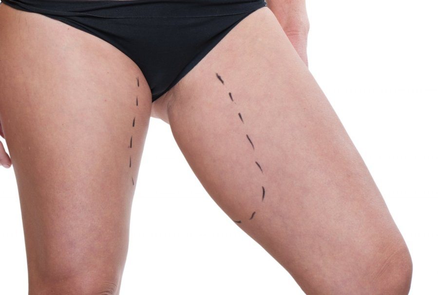Before and after thigh lift surgery showing firmer, smoother inner thighs by Dr. Ali Soueid