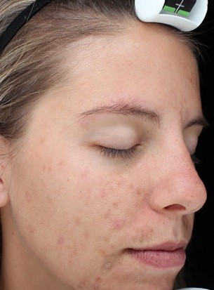 Chemical skin peel treatment by Dr. Ali Soueid for glowing skin in London, Doha, Dubai, Qatar, and Beirut – non-surgical facial rejuvenation