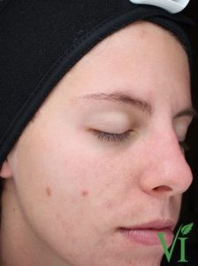 Chemical skin peel treatment by Dr. Ali Soueid for glowing skin in London, Doha, Dubai, Qatar, and Beirut – non-surgical facial rejuvenation