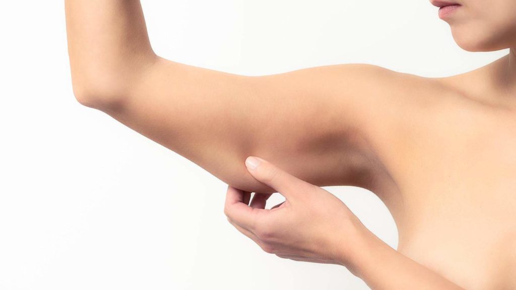 arm lift by Dr. Ali Soueid, showing improved contour and reduced excess skin on the upper arms.