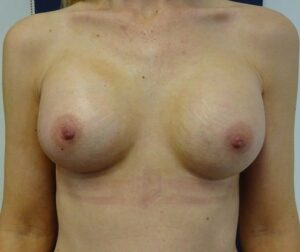 Before and after breast augmentation results by Dr. Ali Soueid using natural-looking silicone implants.