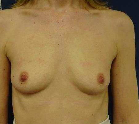 Before and after breast augmentation results by Dr. Ali Soueid using natural-looking silicone implants.