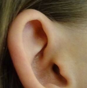 pinnaplasty prominent ear correction manchestr london birmingham doha beirut before after