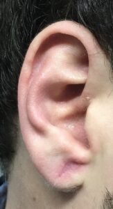 Dr. Ali Soueid repairing a torn earlobe using minor surgical technique in Dubai, Doha, London, or Beirut.