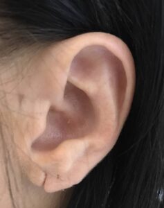 split ear lobe correction surgery london manchester birminghma doha beirut before after