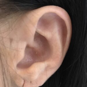 split ear lobe correction surgery london manchester birminghma doha beirut before after