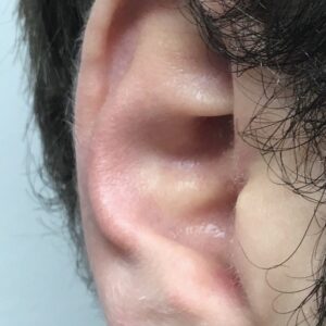 split ear lobe correction surgery london manchester birminghma doha beirut before after