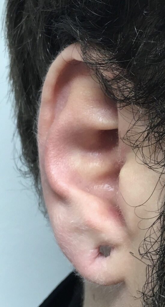 Dr. Ali Soueid repairing a torn earlobe using minor surgical technique in Dubai, Doha, London, or Beirut.