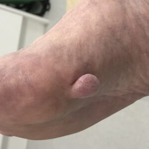 wart treatment