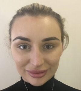 Before and after pinnaplasty ear reshaping surgery showing corrected prominent ears