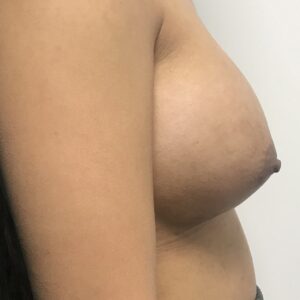breast augmentation enlargement