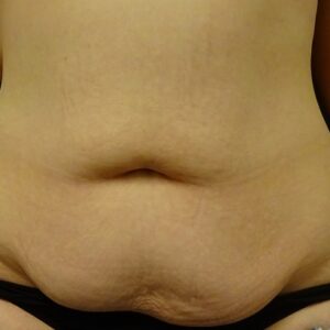 tummy tuck abdominoplasty before after