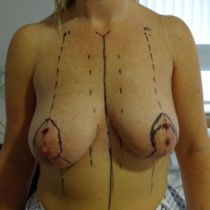 breast lift