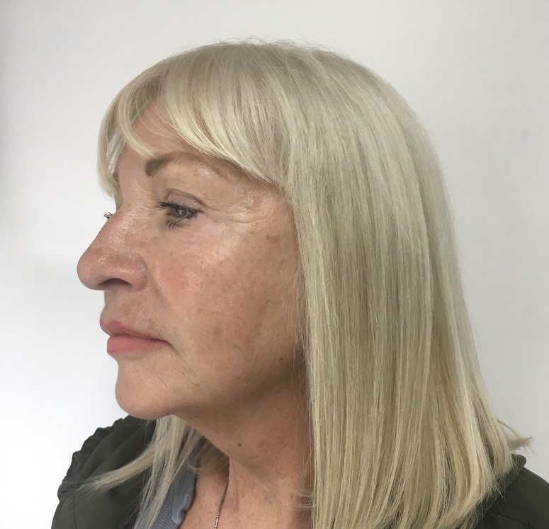 Before and after thread lift showing natural lift and contour enhancement by Dr. Ali Soueid