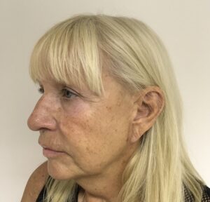 Before and after thread lift showing natural lift and contour enhancement by Dr. Ali Soueid