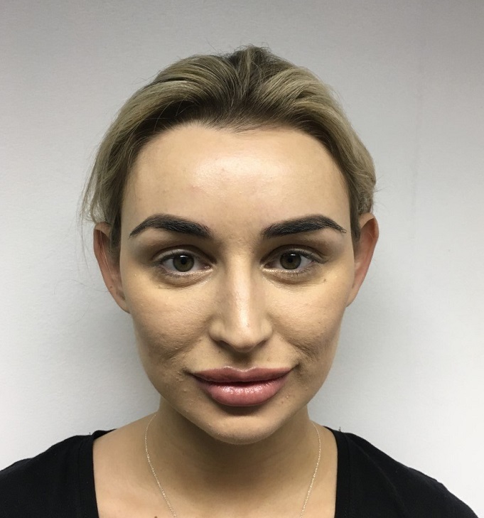 oinnaplasty prominent ears correction batears london doha