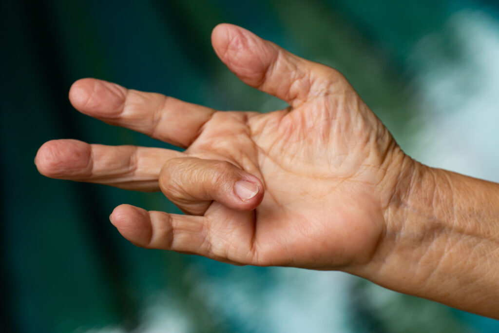 “Hand surgery by Dr. Ali Soueid – illustration showing surgical treatment of carpal tunnel syndrome, tendon injury, and hand deformities in London, Dubai, Doha, and Beirut.”