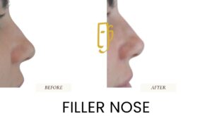“Non-surgical rhinoplasty by Dr. Ali Soueid – medical illustration showing hyaluronic acid filler injection to reshape nasal bridge and tip without surgery in London, Dubai, Doha, and Beirut.”