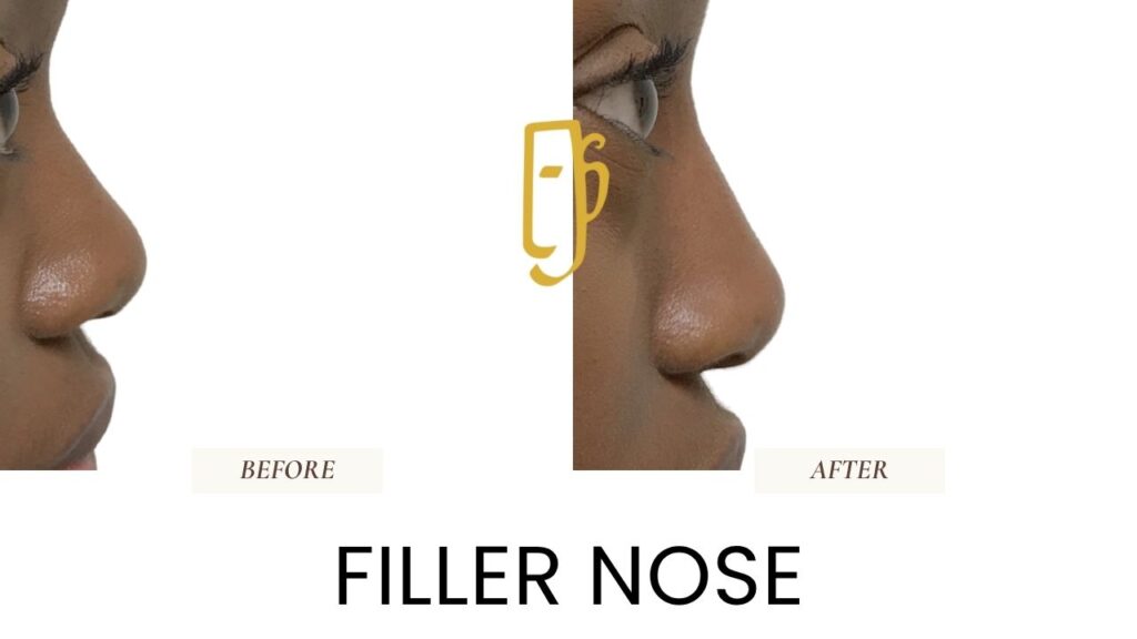 “Non-surgical rhinoplasty by Dr. Ali Soueid – medical illustration showing hyaluronic acid filler injection to reshape nasal bridge and tip without surgery in London, Dubai, Doha, and Beirut.”