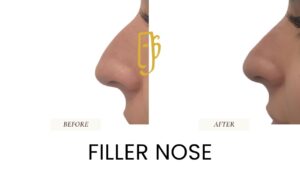 “Non-surgical rhinoplasty by Dr. Ali Soueid – medical illustration showing hyaluronic acid filler injection to reshape nasal bridge and tip without surgery in London, Dubai, Doha, and Beirut.”