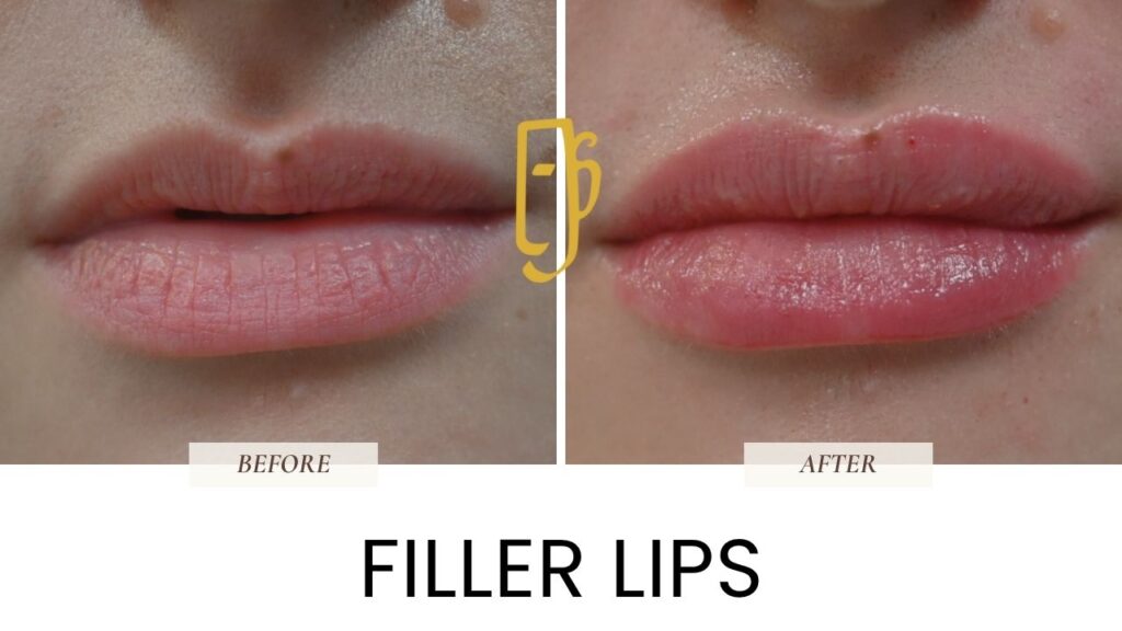 “Lip filler treatment by Dr. Ali Soueid – illustration showing hyaluronic acid injection technique to enhance lip volume, shape, and symmetry in London, Dubai, Doha, and Beirut.”