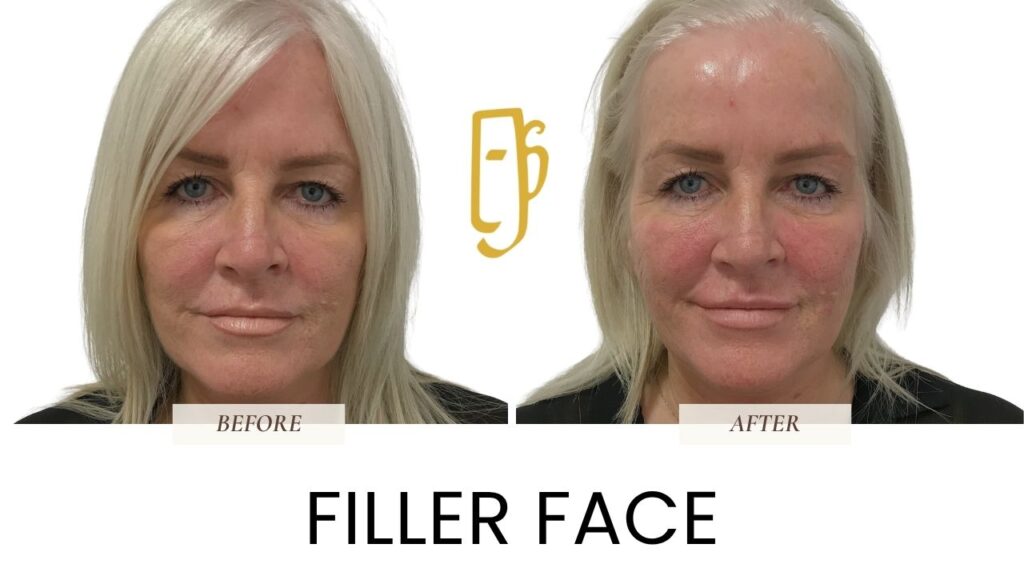 Filler