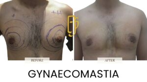 “Male breast reduction (gynaecomastia surgery) by Dr. Ali Soueid – illustration showing gland and fat removal to treat enlarged male chest in London, Dubai, Doha, and Beirut.”