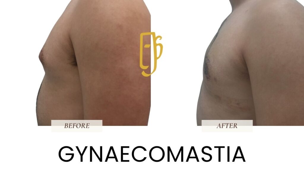 “Male breast reduction (gynaecomastia surgery) by Dr. Ali Soueid – illustration showing gland and fat removal to treat enlarged male chest in London, Dubai, Doha, and Beirut.”