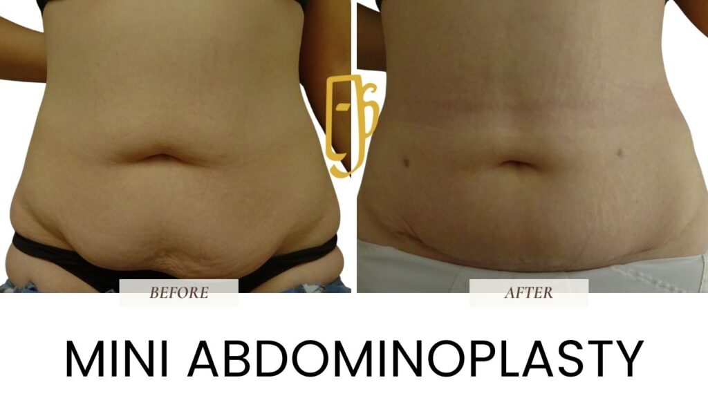 “Before and after tummy tuck (abdominoplasty) by Dr. Ali Soueid – visible improvement in abdominal contour, excess skin removal, and muscle tightening in London, Dubai, Doha, and Beirut.”