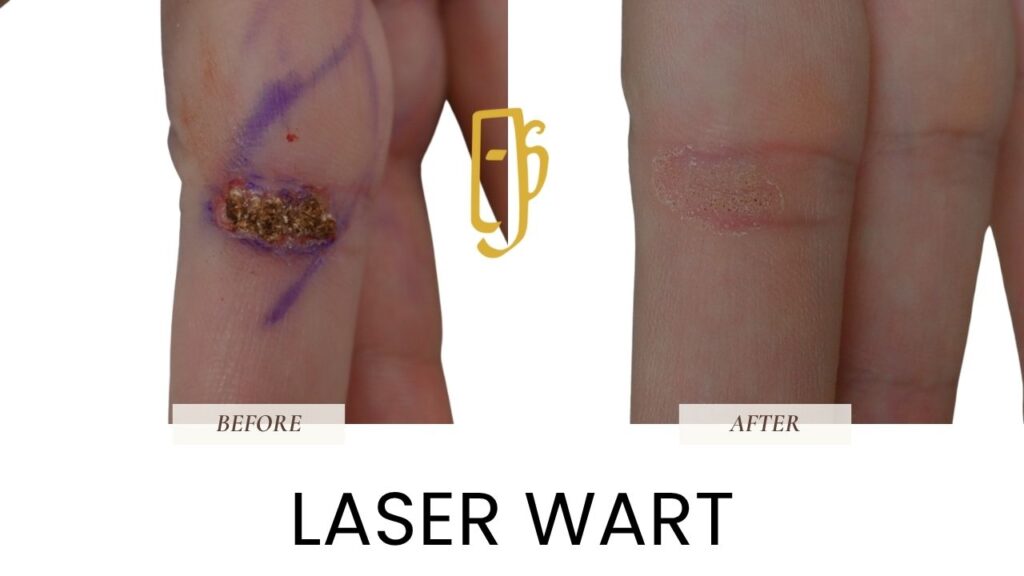 “Laser wart removal by Dr. Ali Soueid – medical illustration showing precise laser treatment of common and plantar warts on hands or feet in London, Dubai, Doha, and Beirut.”