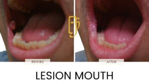 “Skin lesion removal by Dr. Ali Soueid – illustration showing surgical excision of benign or suspicious skin growths such as moles, cysts, or lipomas in London, Dubai, Doha, and Beirut.”