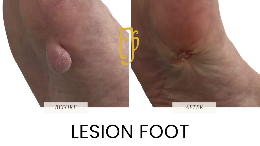 “Skin lesion removal by Dr. Ali Soueid – illustration showing surgical excision of benign or suspicious skin growths such as moles, cysts, or lipomas in London, Dubai, Doha, and Beirut.”