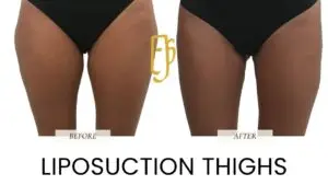 “Liposuction by Dr. Ali Soueid – medical illustration showing fat removal from abdomen, thighs, and flanks using suction cannulas in London, Dubai, Doha, and Beirut.”