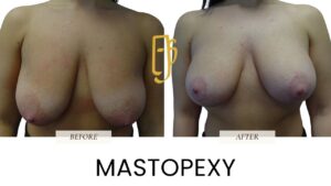 “Breast lift (mastopexy) by Dr. Ali Soueid – medical illustration showing removal of excess skin and reshaping of sagging breasts for a lifted, youthful contour in London, Dubai, Doha, and Beirut.”