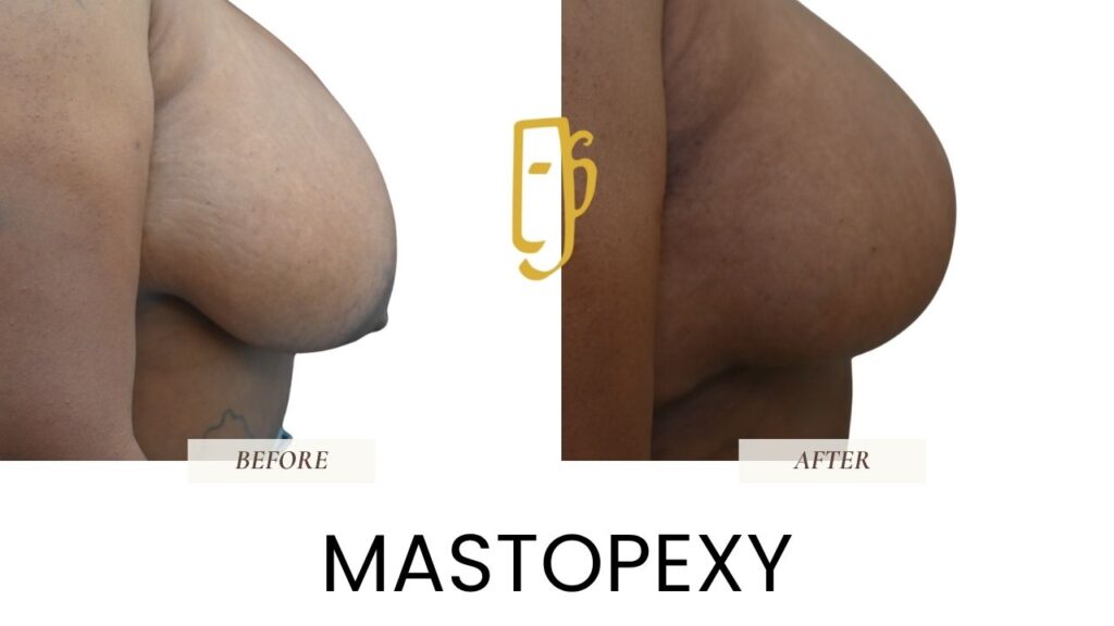 “Breast lift (mastopexy) by Dr. Ali Soueid – medical illustration showing removal of excess skin and reshaping of sagging breasts for a lifted, youthful contour in London, Dubai, Doha, and Beirut.”