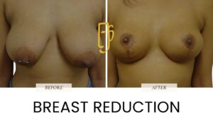 “Breast reduction surgery by Dr. Ali Soueid – diagram showing removal of excess breast tissue and skin to relieve discomfort and achieve smaller, balanced breast shape in London, Dubai, Doha, and Beirut.”