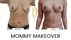 “Mommy Makeover by Dr. Ali Soueid – diagram showing combination of breast surgery, tummy tuck, and liposuction to restore body after pregnancy in London, Dubai, Doha, and Beirut.”