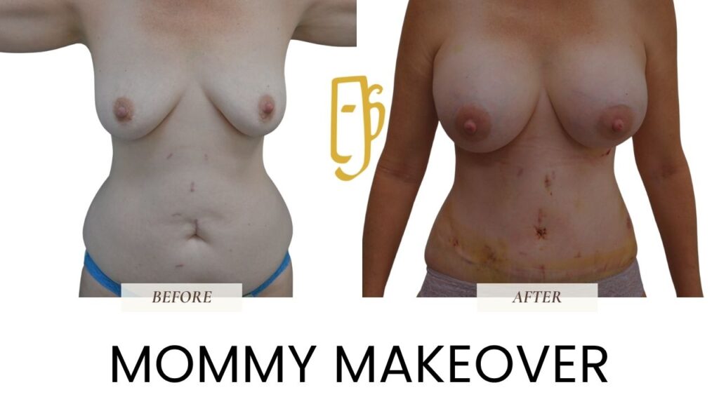 “Mommy Makeover by Dr. Ali Soueid – diagram showing combination of breast surgery, tummy tuck, and liposuction to restore body after pregnancy in London, Dubai, Doha, and Beirut.”