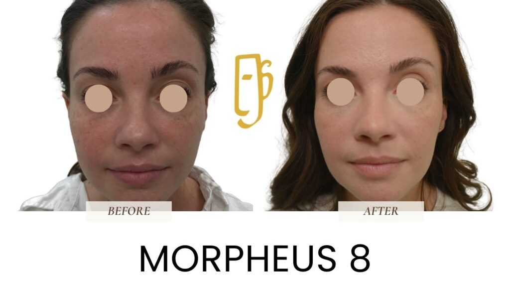 “Morpheus8 treatment by Dr. Ali Soueid – illustration showing microneedling with radiofrequency technology to tighten skin and contour face or body in London, Dubai, Doha, and Beirut.”