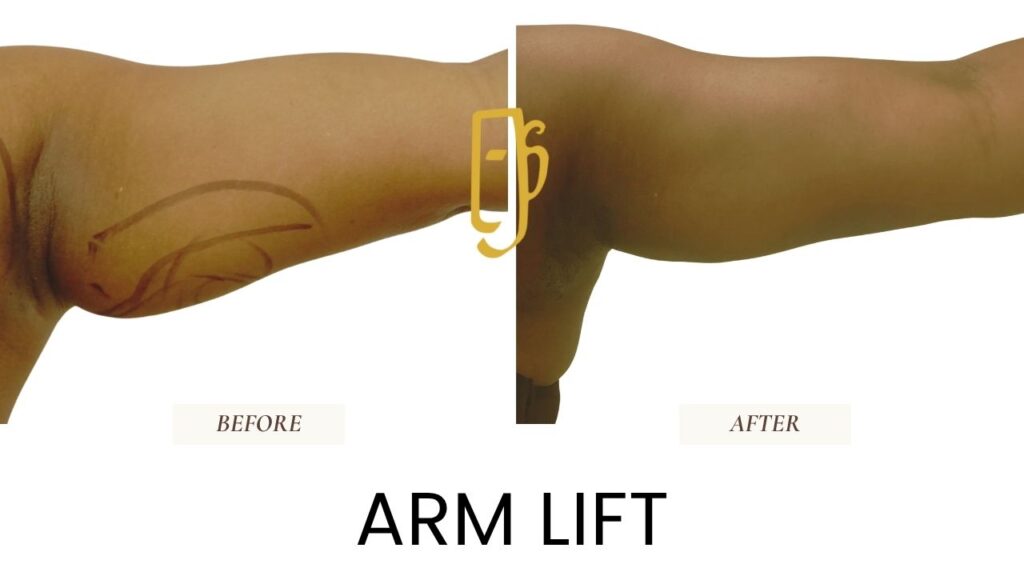 “Arm lift (brachioplasty) by Dr. Ali Soueid – medical illustration showing removal of excess skin and fat from upper arms to restore firmness and contour in London, Dubai, Doha, and Beirut.”