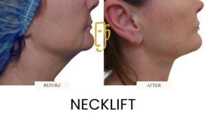 “Facelift surgery by Dr. Ali Soueid – illustration showing SMAS layer lifting and skin tightening to restore youthful facial contours in London, Dubai, and Doha.”