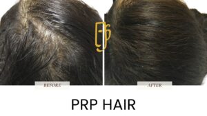 “PRP hair restoration by Dr. Ali Soueid – illustration showing platelet-rich plasma injections into scalp to treat hair thinning and stimulate regrowth in London, Dubai, Doha, and Beirut.”