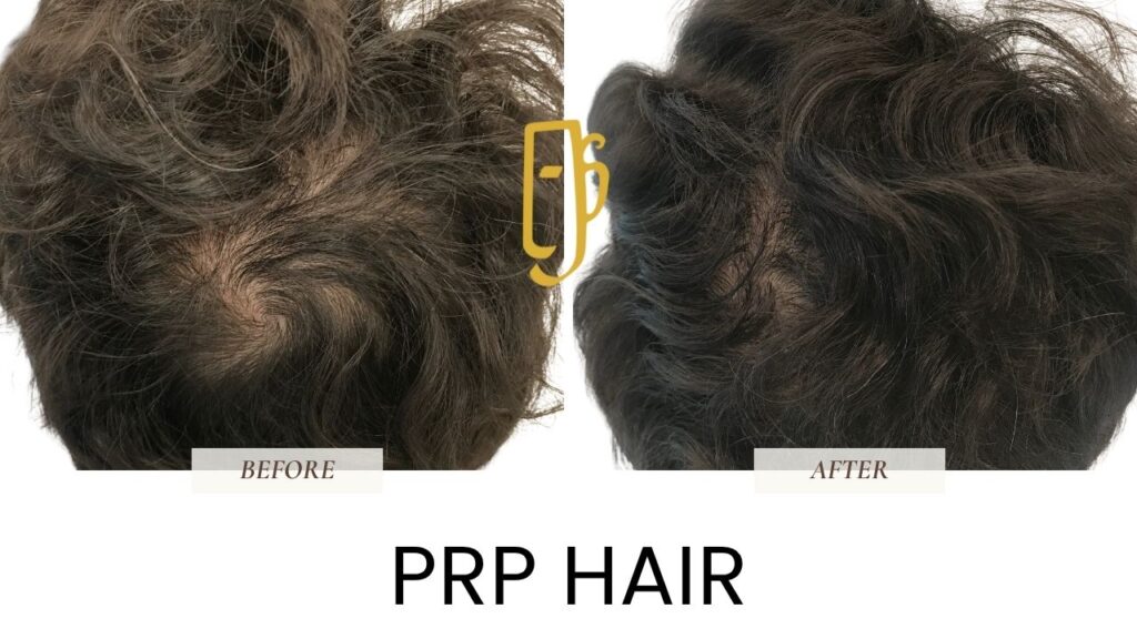 “PRP hair restoration by Dr. Ali Soueid – illustration showing platelet-rich plasma injections into scalp to treat hair thinning and stimulate regrowth in London, Dubai, Doha, and Beirut.”