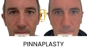 “Pinnaplasty surgery by Dr. Ali Soueid – medical illustration showing ear pinning to correct prominent ears and improve facial balance in London, Dubai, and Doha.”