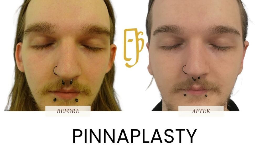 “Pinnaplasty surgery by Dr. Ali Soueid – medical illustration showing ear pinning to correct prominent ears and improve facial balance in London, Dubai, and Doha.”