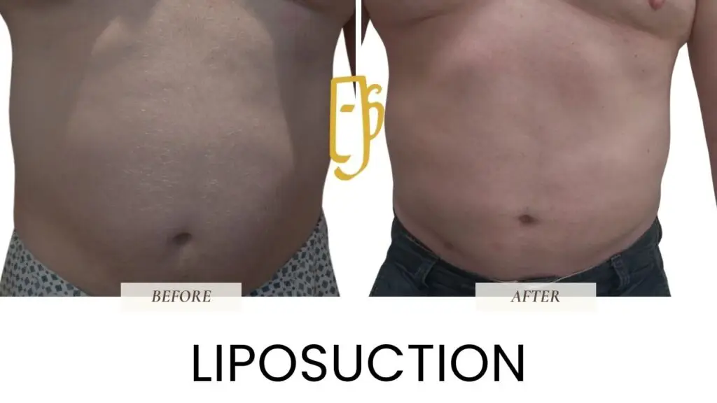 “Liposuction by Dr. Ali Soueid – medical illustration showing fat removal from abdomen, thighs, and flanks using suction cannulas in London, Dubai, Doha, and Beirut.”